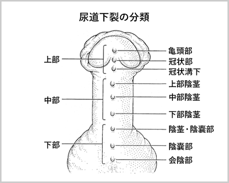 尿道下裂の分類