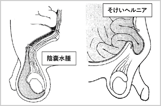 陰嚢水腫（陰嚢水瘤、精索水瘤）