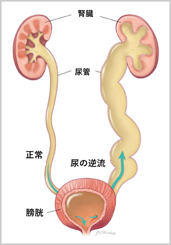 尿路と尿路感染症