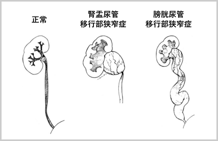 水腎症とは