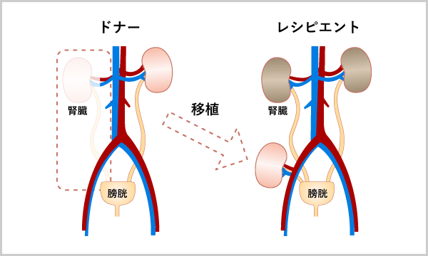 レシピエント手術（移植手術）