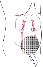 自然排尿型代用膀胱（回腸新膀胱など）