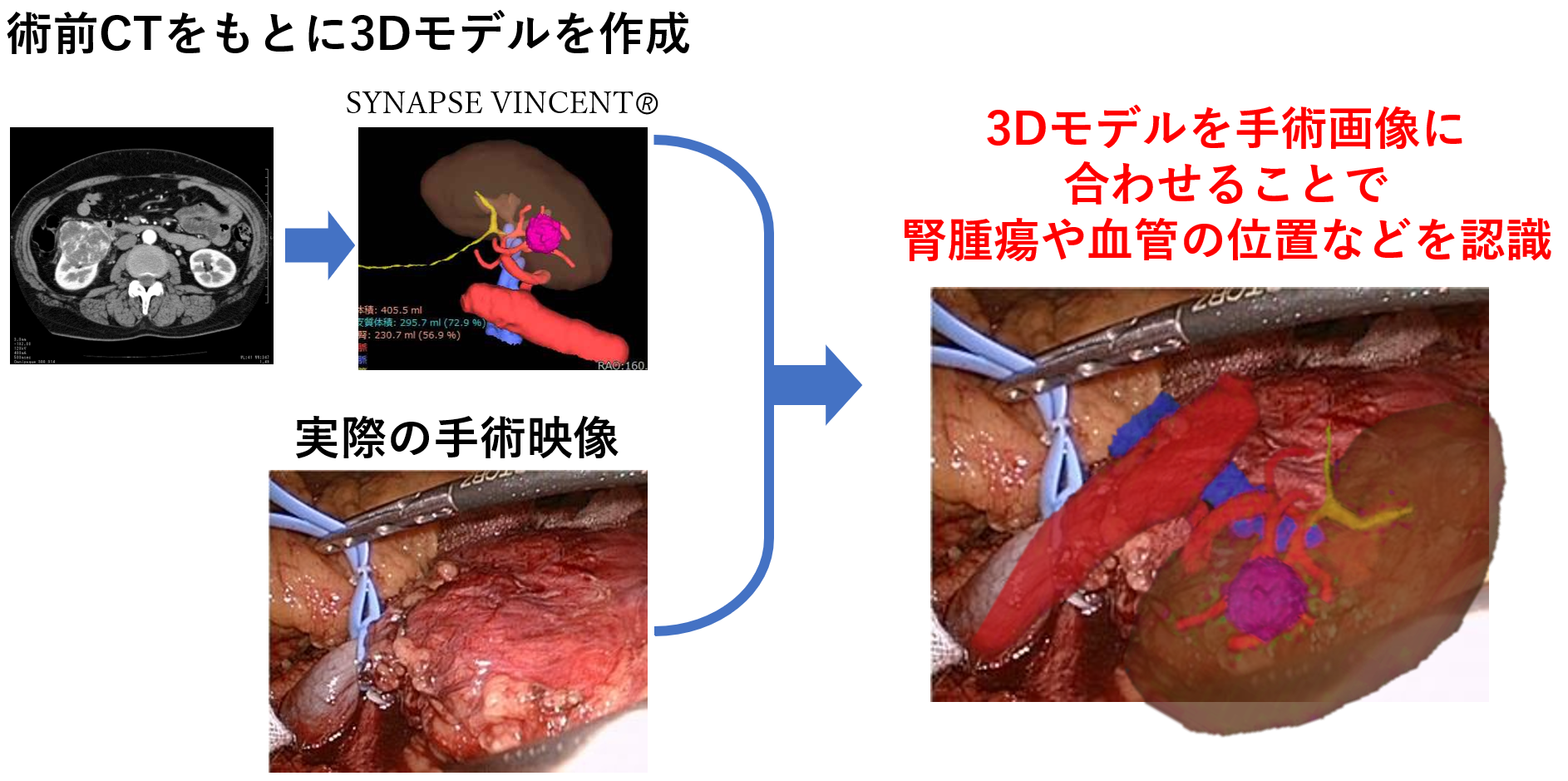 術前CTをもとに3Dモデルを作成